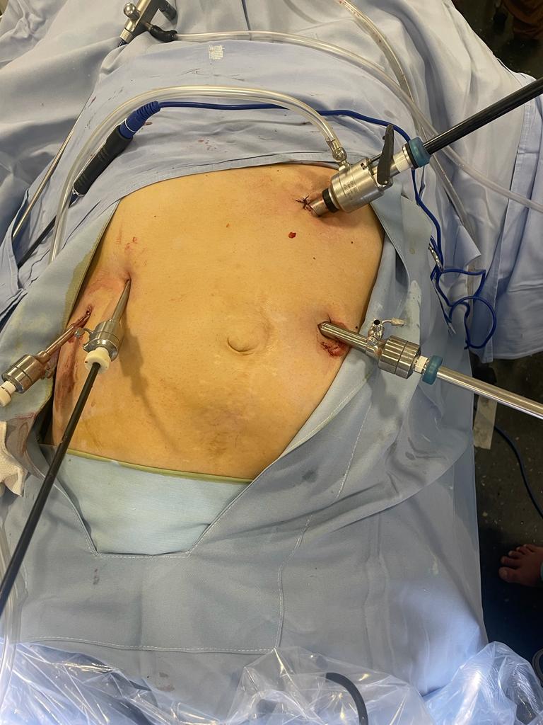 Colecistectomia Compleja por gran eventracion abdominal y cicatrices previas con adherencias internas